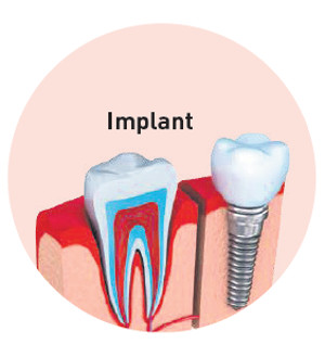 implant vitaldent- La Veu de l'Anoia - VeuAnoia.cat