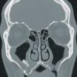 Cos extrany intrasinusal